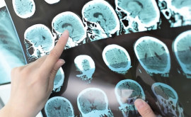 Oamenii de știință japonezi au găsit o nouă modalitate de a detecta cancerul cerebral