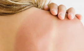 Cinci remedii simple și eficiente pentru a calma pielea inflamată și dureroasă de arsurile solare