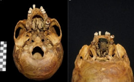 Первый в своем роде найден 300летний челюстной протез из золота