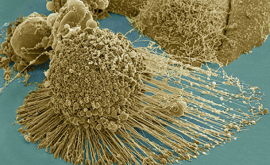 A fost găsită metoda de îmbătrînire a celulelor canceroase 