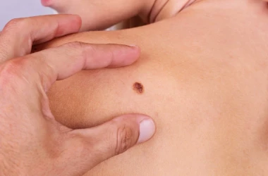 В Молдове растет число случаев заболевания раком кожи